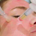 prp-microneedling