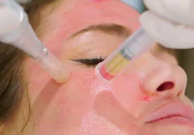 prp-microneedling