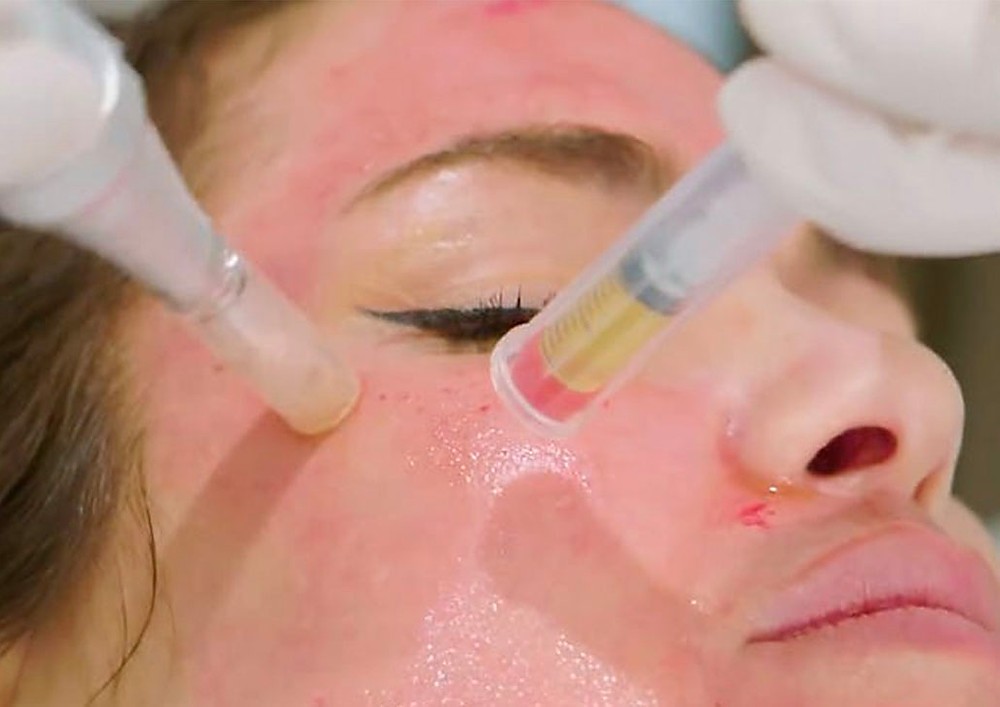 prp-microneedling